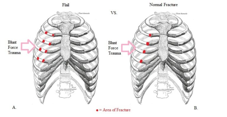 FLAIL Chest – Causes, Treatment and Complications
