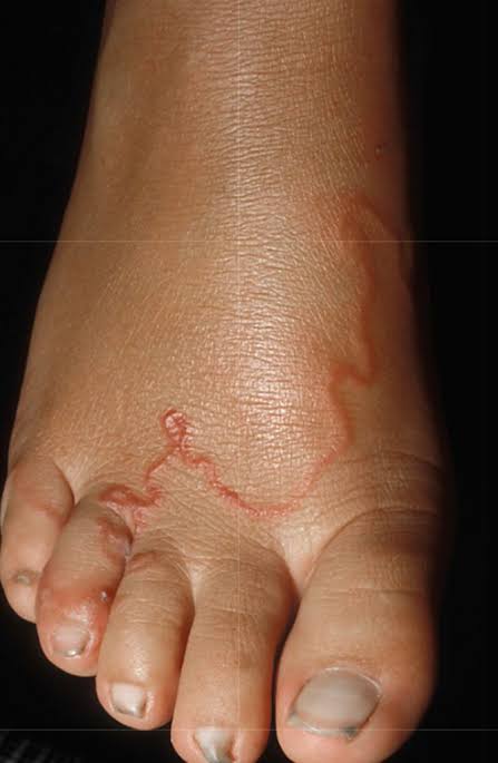 Cutaneous Larva Migrans – causes and Treatment