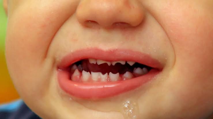 Hutchinson Teeth - Congenital syphilis 