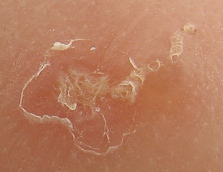 Scabies Burrows in skin by mite