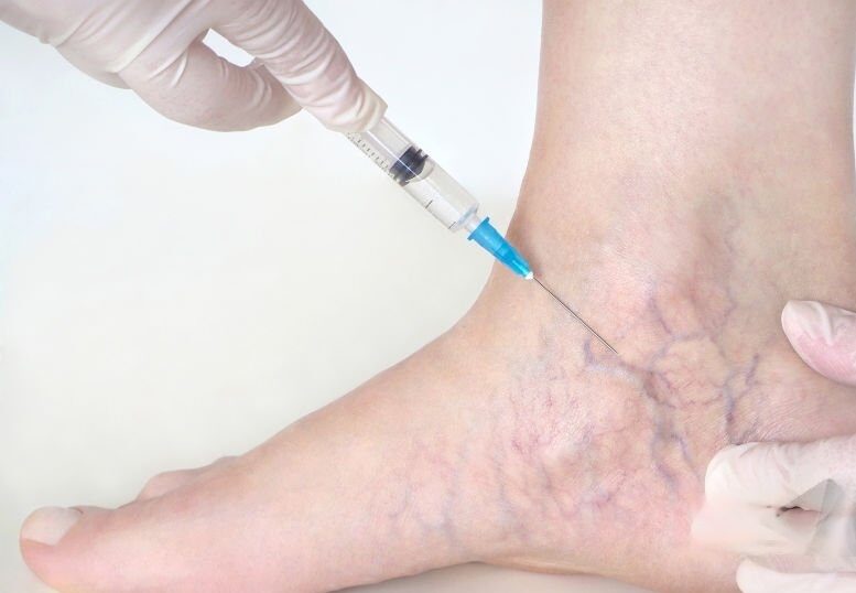 sclerotherapy - Modern HealthMe