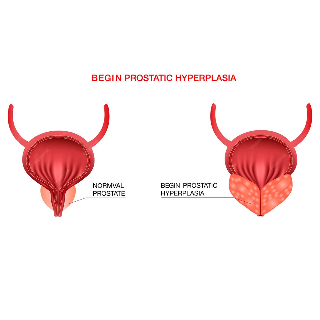 benign prostatic hyperplasiaeditable vector illustration realistic style 426524 34