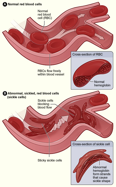 sickle cell crisis - Sickle cell anemia - Modern HealthMe, Healthline, WebMD 