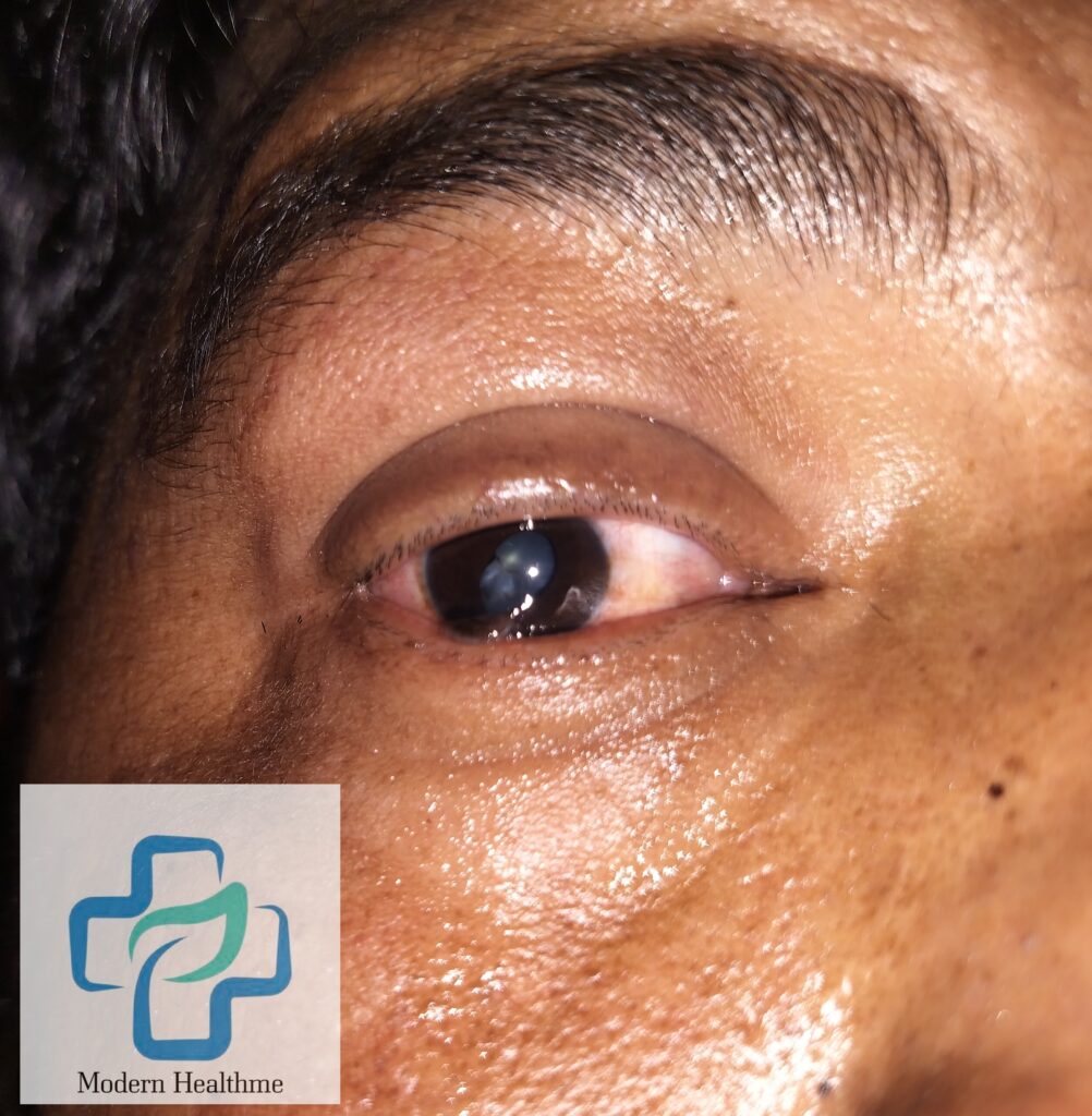 Traumatic or rossete cataract - Modern HealthMe, Healthline, WebMD, Eyewiki