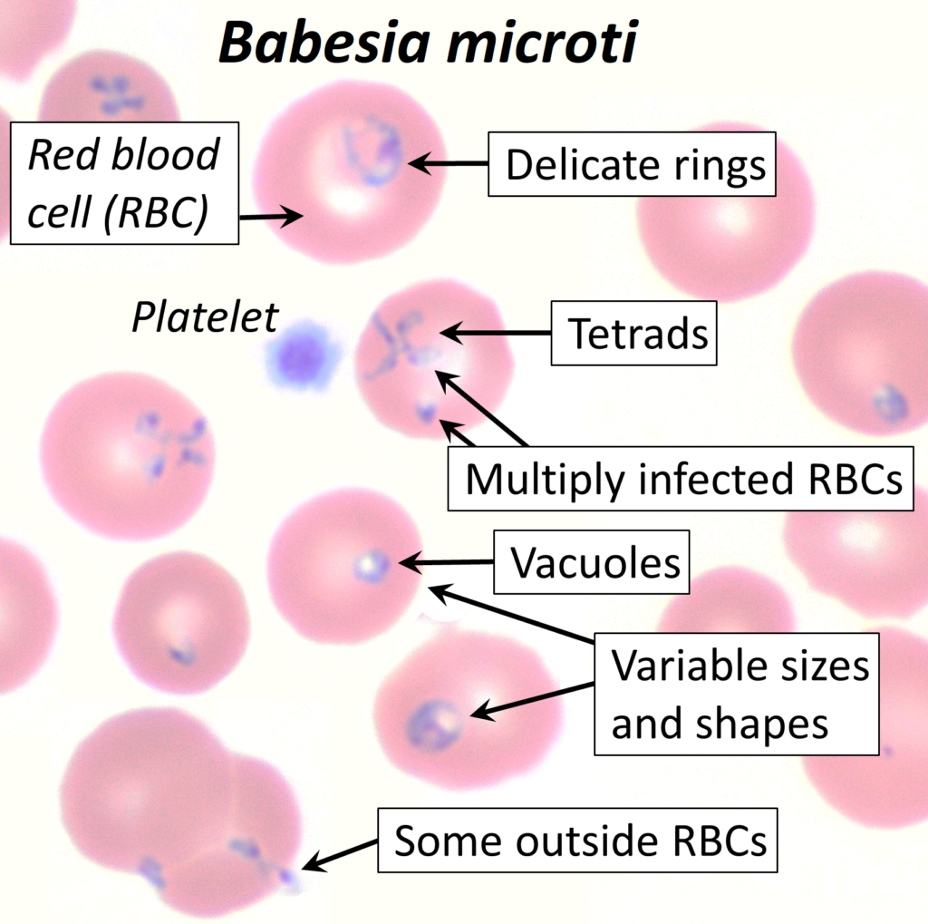 Babesia Microti - Babesiosis - Modern HealthMe, Healthline, WebMD 