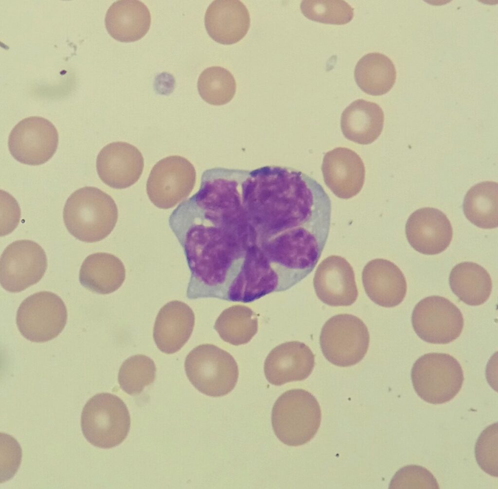 Flower cell in adult t cell Leukemia/Lymphoma 