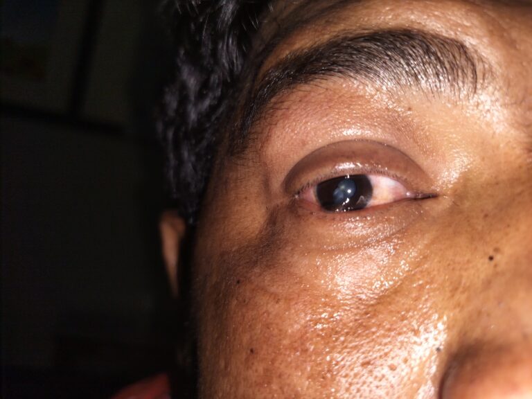 What is Traumatic Cataract Or Rosete cataract?