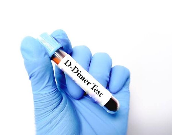 D-Dimer Test: What It Is and Why It Matters